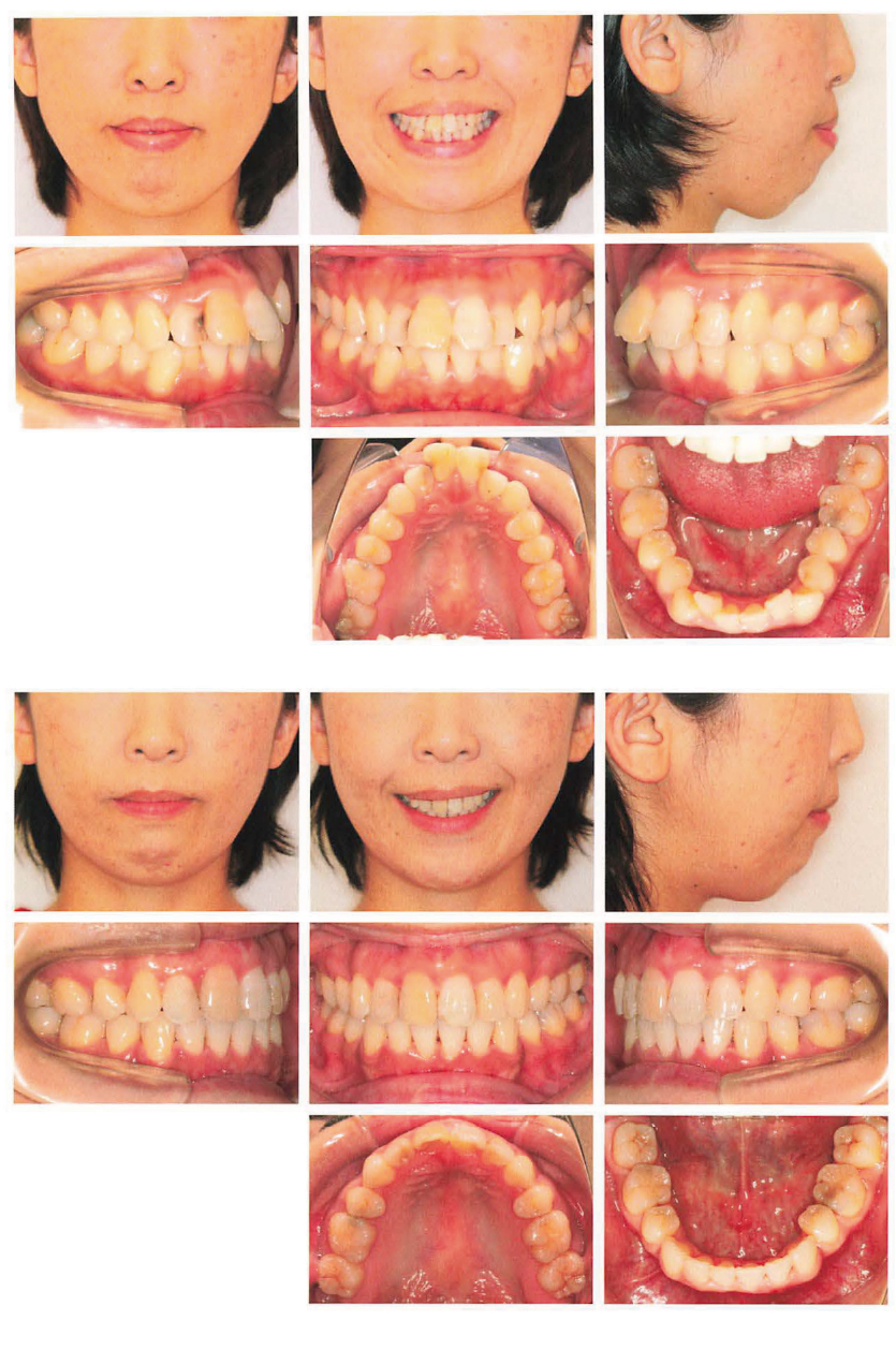 Before and after comparison: facial profile and intraoral photos before and after 15 months of aligner treatment with premolar extraction
