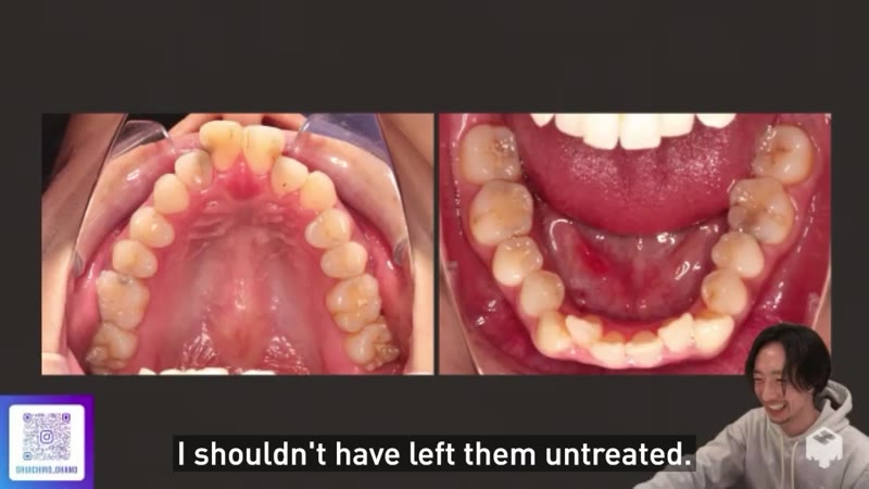 Initial diagnosis - severe crowding