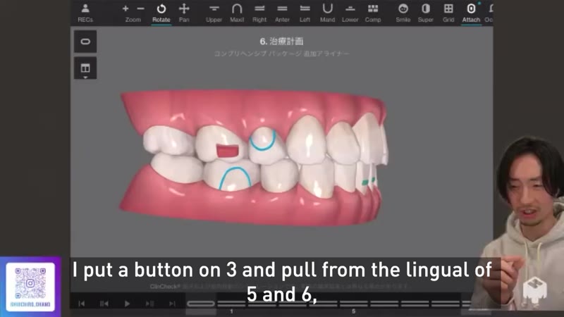 Strategic refinement aligners